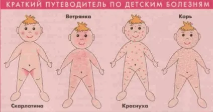 Вірусна екзантема у дітей ознаки, причини, лікування, фото (лікування) Вірусна екзантема у дітей ознаки, причини, лікування, фото