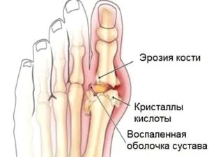 Подагра у чоловіків які її симптоми і від чого вона з'являється (подагра) Подагра у чоловіків які її симптоми і від чого вона з'являється