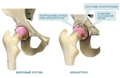 Чому хрустять суглоби по всьому тілу і що робити в такому випадку (всьому) Чому хрустять суглоби по всьому тілу і що робити в такому випадку