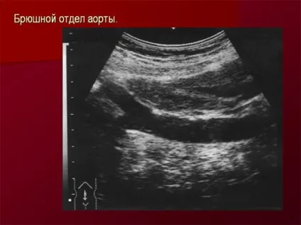 Підготовка до узі черевної порожнини і нирок - як роблять (черевної) Підготовка до узі черевної порожнини і нирок - як роблять
