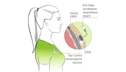 Порти для хіміотерапії і установка інфузійної порт-системи