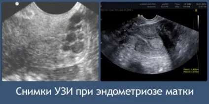 причини ендометріозу