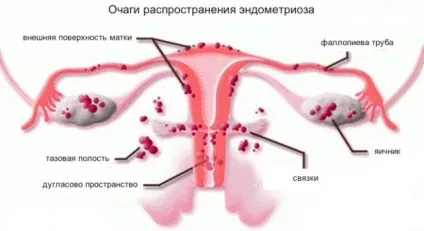 причини ендометріозу