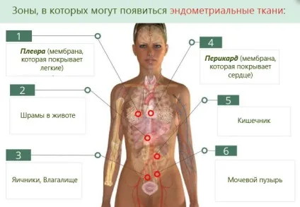 причини ендометріозу