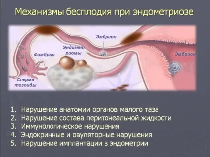 причини ендометріозу