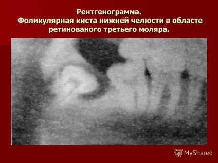 Презентація на тему лекція з хірургічної стоматології на тему пухлиноподібні новоутворення (остеодисплазія і остеодистрофія) Презентація на тему лекція з хірургічної стоматології на тему пухлиноподібні новоутворення
