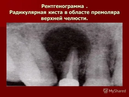 Презентація на тему лекція з хірургічної стоматології на тему пухлиноподібні новоутворення (лекція) Презентація на тему лекція з хірургічної стоматології на тему пухлиноподібні новоутворення