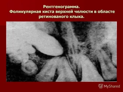 Презентація на тему лекція з хірургічної стоматології на тему пухлиноподібні новоутворення (презентація) Презентація на тему лекція з хірургічної стоматології на тему пухлиноподібні новоутворення
