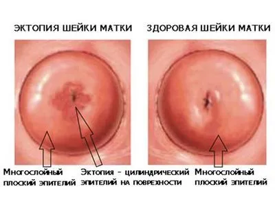 Припікання радіохвилями ерозії шийки матки