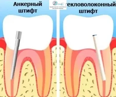 Протезування зубів на штифтах в стоматології в москві, переваги реставрації зубного ряду з (протезування зубів на штифтах) Протезування зубів на штифтах в стоматології в москві, переваги реставрації зубного ряду з