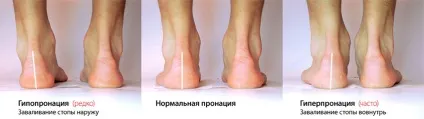 Пронація стопи, що це