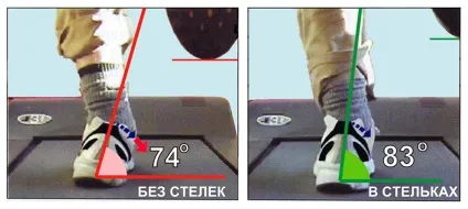 Пронація стопи, що це
