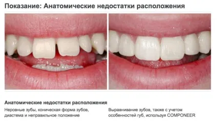 Прямі композитні вініри (компонуються, componeer) відгуки, фото, ціна