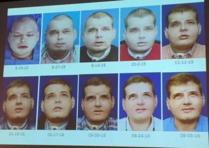 Пройшов рік, і людина з пересадженим обличчям став абсолютно нормальним (став) Пройшов рік, і людина з пересадженим обличчям став абсолютно нормальним