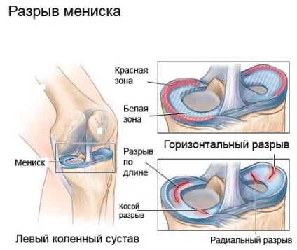 Розрив заднього рогу медіального меніска колінного суглоба лікування, операція (меніска) Розрив заднього рогу медіального меніска колінного суглоба лікування, операція