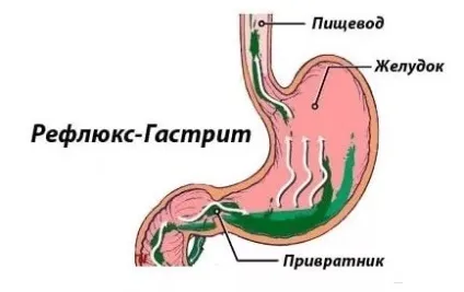 Рефлюкс гастрит симптоми і лікування дієта - поверхневий рефлюксна гастрит