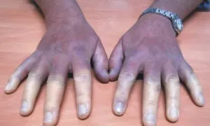 Водянисті пухирці на руках причини і лікування