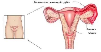 Запалення придатків причини, симптоми, лікування і профілактика (запалення) Запалення придатків причини, симптоми, лікування і профілактика