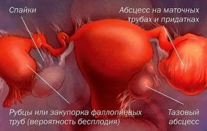 Запалення придатків причини, симптоми, лікування і профілактика (симптоми) Запалення придатків причини, симптоми, лікування і профілактика