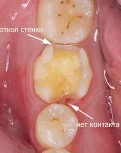 Реставрація жувальних зубів - фото до і після, ціни, відгуки (фото) Реставрація жувальних зубів - фото до і після, ціни, відгуки