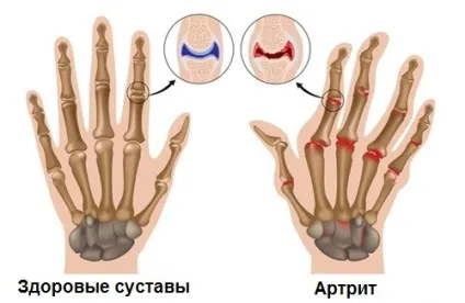 Ревматоїдний артрит 7 простих кроків, щоб полегшити хвороба - крок до здоров'я (ревматоїдний) Ревматоїдний артрит 7 простих кроків, щоб полегшити хвороба - крок до здоров'я