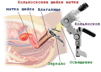 Ретенційні кісти шийки матки причини виникнення, лікування (кісти) Ретенційні кісти шийки матки причини виникнення, лікування