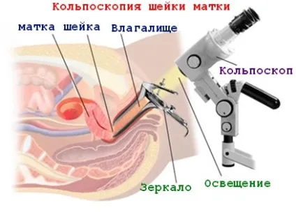 Результати кольпоскопії розшифруйте і дізнайтеся, чи є привід для занепокоєння (кольпоскопії) Результати кольпоскопії розшифруйте і дізнайтеся, чи є привід для занепокоєння
