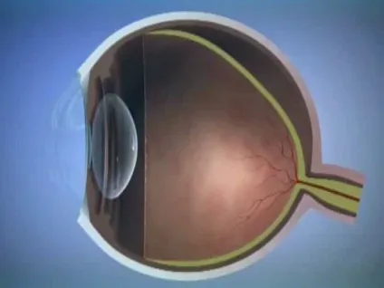 Retinal detachment, курс по зору іскра світла (зору) Retinal detachment, курс по зору іскра світла