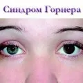 Синдром кубитального каналу лікування, операція, симптоми, причини (операція) Синдром кубитального каналу лікування, операція, симптоми, причини