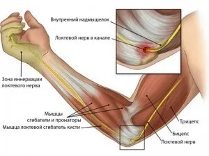 Синдром кубитального каналу (синдром) Синдром кубитального каналу