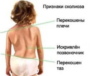 Сколіоз у дітей правильне лікування викривлення хребта (сколіоз) Сколіоз у дітей правильне лікування викривлення хребта