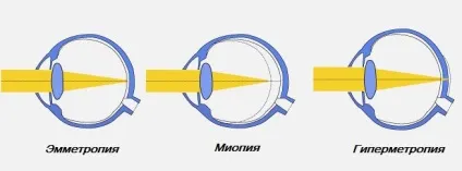 Симптоми і причини амбліопії, про хвороби очей (причини) Симптоми і причини амбліопії, про хвороби очей