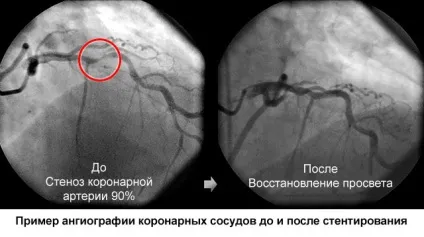 Скільки живуть після операції стентування серця, чи дають інвалідність (серця) Скільки живуть після операції стентування серця, чи дають інвалідність