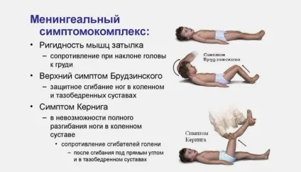 Симптом Керніга і Брудзинського причини і діагностика (Керніга) Симптом Керніга і Брудзинського причини і діагностика