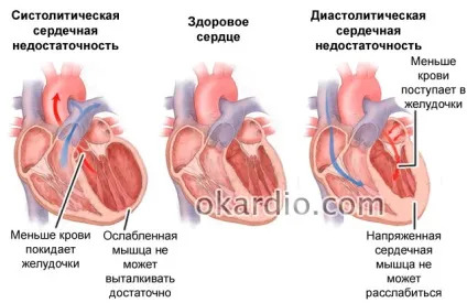 Скільки живуть після операції стентування серця, чи дають інвалідність (стентування) Скільки живуть після операції стентування серця, чи дають інвалідність