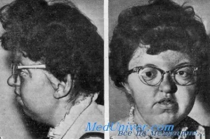 Синдром аперта у плода