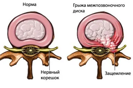 Симптоми грижі хребта і фото ознак захворювання (задньої поздовжньої зв'язки) Симптоми грижі хребта і фото ознак захворювання