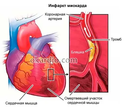 Скільки живуть після операції стентування серця, чи дають інвалідність (серця) Скільки живуть після операції стентування серця, чи дають інвалідність