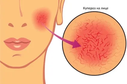 Купероз на обличчі лікування народними засобами і ратамі (особі) Купероз на обличчі лікування народними засобами і ратамі