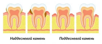 Засіб від зубного каменю професійні і народні методи (каменю) Засіб від зубного каменю професійні і народні методи