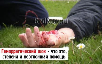 Ступеня, причини виникнення та невідкладна допомога при геморагічному шоці (ступеня) Ступеня, причини виникнення та невідкладна допомога при геморагічному шоці