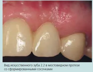 Стоматологічна «рожева естетика» (Клас рецесія крайової) Стоматологічна «рожева естетика»