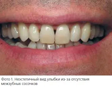 Стоматологічна «рожева естетика» (рожева) Стоматологічна «рожева естетика»