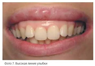 Стоматологічна «рожева естетика» (рожева) Стоматологічна «рожева естетика»