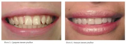 Стоматологічна «рожева естетика» (міжзубних твердих м'яких) Стоматологічна «рожева естетика»