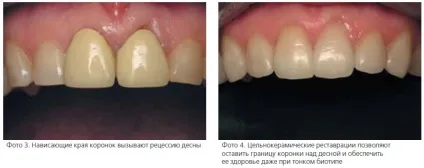Стоматологічна «рожева естетика» (міжзубних твердих м'яких) Стоматологічна «рожева естетика»