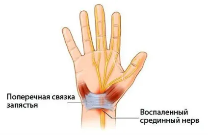 Стілоідіт лучезапястного суглоба (променевої кістки) лікування і симптоми (променевої) Стілоідіт лучезапястного суглоба (променевої кістки) лікування і симптоми