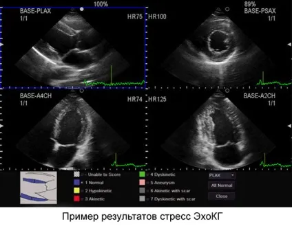 Стрес ехокардіографія що це таке, показання, види процедури (показання) Стрес ехокардіографія що це таке, показання, види процедури