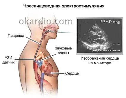 Стрес ехокардіографія що це таке, показання, види процедури (види) Стрес ехокардіографія що це таке, показання, види процедури