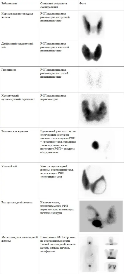 Сцинтиграфія щитовидної залози, підготовка і як її проводять (щитовидної) Сцинтиграфія щитовидної залози, підготовка і як її проводять